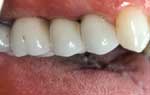 Replacing Single Tooth